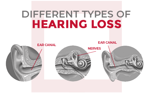 different types of hearing loss